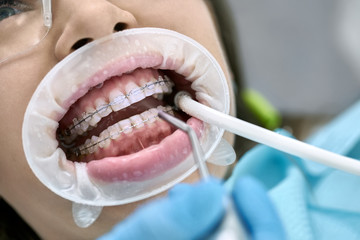 Pretty woman's teeth cleaning in dental clinic