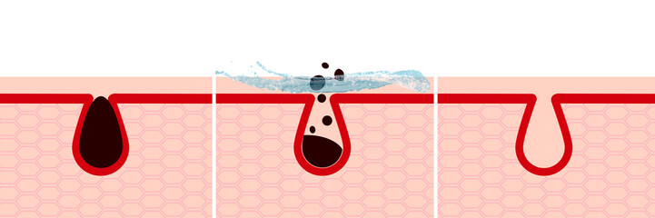 Infograph with polluted and clean the pores on face.