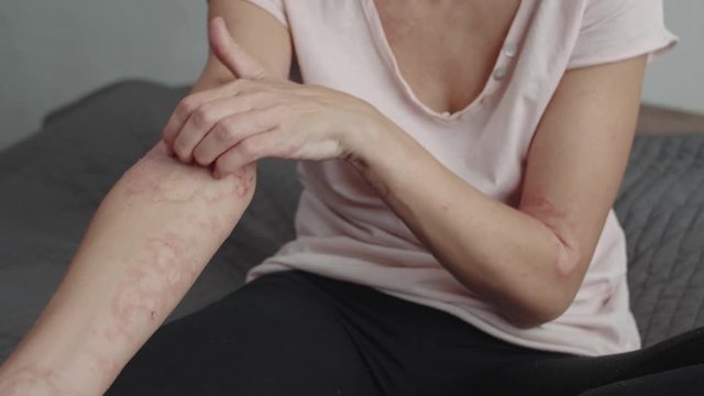 scratches arm with rash or dermatitis