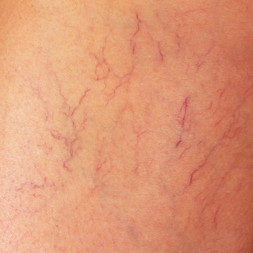 varicose veins on the thigh of a woman close up