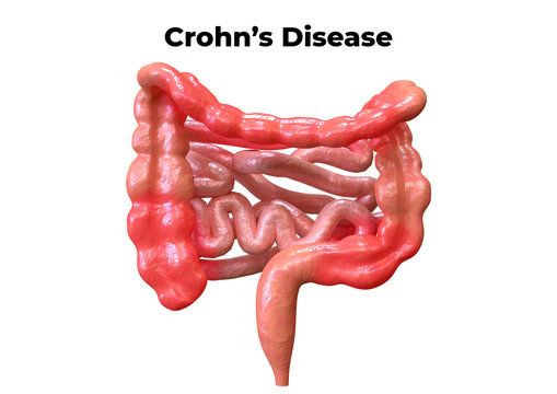 Crohn's disease is a syndrome that affects the digestive system. Its symptoms are abdominal pain associated with diarrhea, fever, weight loss and weakening.