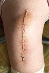 wound after a knee prosthesis operation