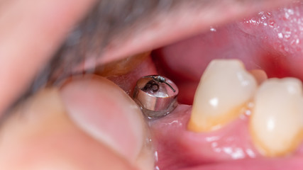 Fototapeta premium Super closeup macro view of dental implant