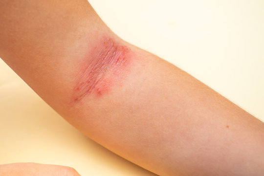 Atopic exema on hand. Baby hand with exema close up.