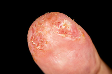 Closeup of eczema dermatitis allergic skin rash on male thumb with skin peeling. . Isolated over black background. Macro. Shallow depth of field.