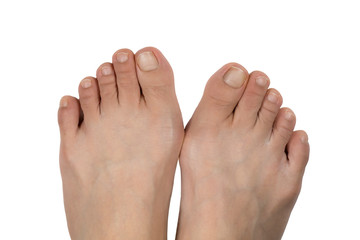 Hallux Valgus  , Bunion in foot on isolated white background with clipping path