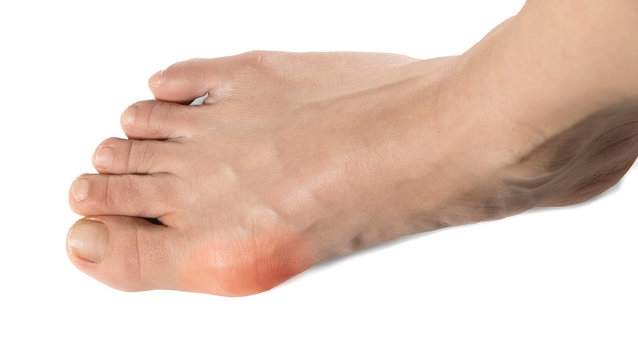 Hallux Valgus , Bunion in foot with pain on the bone on isolated white background