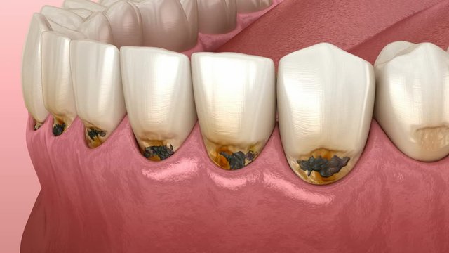 Cervical caries on frontal teeth. Medically accurate tooth 3D animation