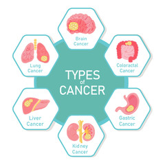 Types of Cancer infographics Vector Illustration.