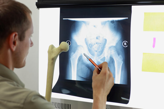 Professional with femur bone model watching image of hip- joint,  pelvis at x-ray film viewer. Diagnosis,treatment planning