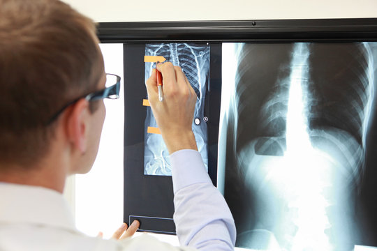 Case study . Doctor working with   images of chest and spine  at x-ray film viewer. Diagnosis,treatment planning