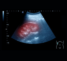 Ultrasound images of kidney examination, showing medullary nephrocalcinosis and inflammation, a 13...