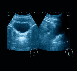 Ultrasound images of bladder, a case of medullary nephrocalcinosis of kidney, a 13 year old Asian...