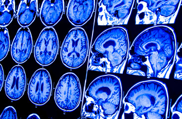 Computerized x-ray image of the patient's body for treatment.research in medicine. CT scan of the patient.