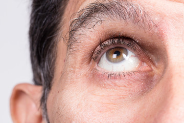 Man looking upwards, showing capillaries closeup