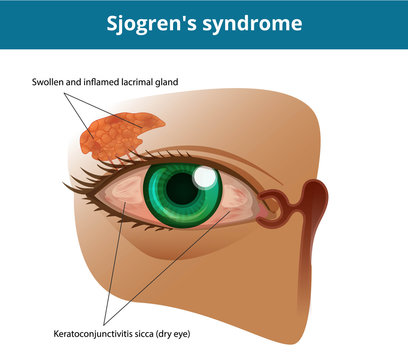 Sjogren's syndrome or dry eye syndrome. Keratoconjuctivitis sicca