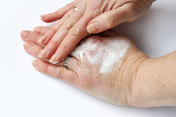 Eine Frau reibt ihre Hände mit einer Schmerzsalbe ein. Handcreme gegen trockene Haut