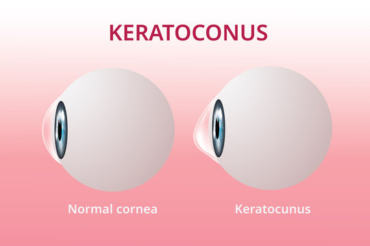 Eye Cornea And Keratoconus, Eye Disorder, Medical Vector