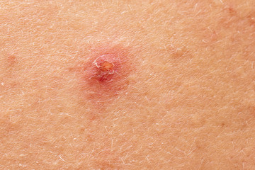 Ripped crust on skin, dermatitis close up