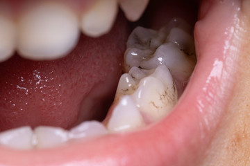 Human tooth decay, plaque, caries close up