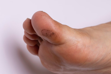 Toe callus, foot finger corns close up