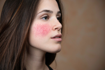 Beautiful young woman with rosacea - obrazy, fototapety, plakaty