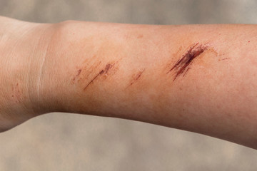 The wound form scabs on hand and arm. The wound happen during woman Injuries from falling down on road.