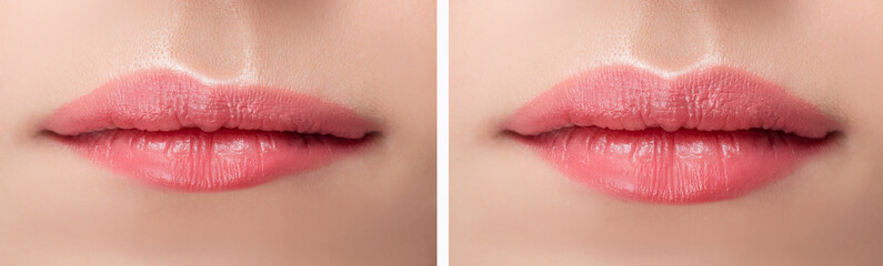 Before and after lips filler injections. Beauty plastic augmentation procedure - obrazy, fototapety, plakaty