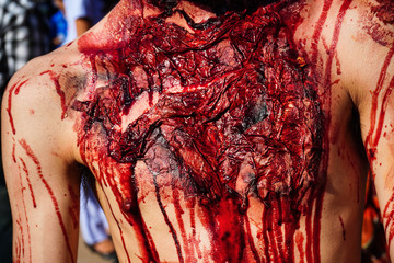 Traumatic injury patients with blood in the emergency room after the accident