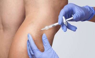 A doctor does medical procedure Sclerotherapy used to eliminate varicose veins and spider veins. An...