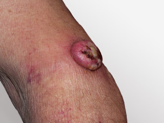 Bösartiger Tumor auf Haut eines Mannes