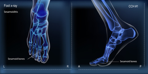 Medial and top view x ray of bones the of foot with sesamoid.