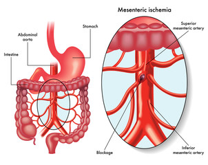 Medical illustration showing a mesenteric  ischemia also called intestinal infarction, a blockage of blood circulation, affecting  the mesenteric artery.