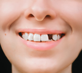 Smile of a young woman without one front tooth. .Consequences  of caries, dental diseases, sugar...