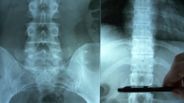 Clinician Discussing X-Ray Image of Patient's Spine and Chest Using Pen Pointer