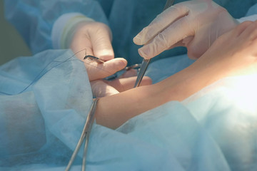 Surgeon man sutures ankle during surgery with neat stitches after removing hygroma using clip, hands closeup. Doctor sewing on wound in operating room in hospital. Seams with self-absorbable threads. - obrazy, fototapety, plakaty