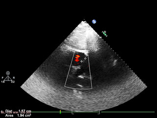 Screen of echocardiography (ultrasound) machine.