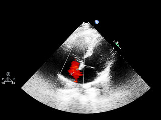Screen of echocardiography (ultrasound) machine.