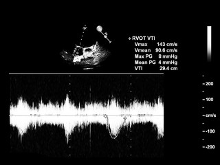 Screen of echocardiography (ultrasound) machine.