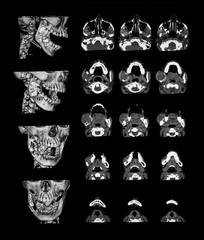  CT scan (computed tomography) of the mandible, a case of keratocystic odontogenic tumour (also keratocystic odontogenic tumor, KCOT)