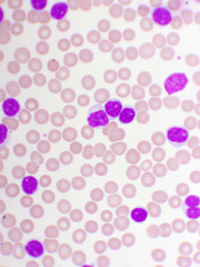 Blood picture of chronic lymphocytic leukemia or CLL, analyze by microscope, original magnification...