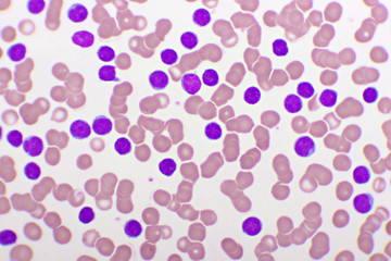 Blood picture of chronic lymphocytic leukemia or CLL, analyze by microscope, original magnification 1000x