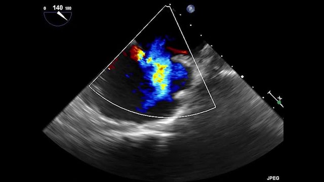Transesophageal Ultrasound Echocardiography.