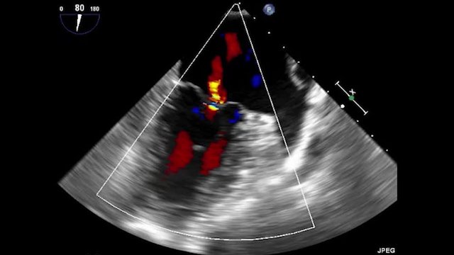 Transesophageal Ultrasound Echocardiography.