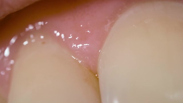 Front tooth with tartar and dental fillings needing in dental treatment