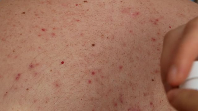close-up of man woman skin with acne dermatitis. doctor open tube with skincare cream ointment and applies to several pimples spots. macro 4k UHD video footage