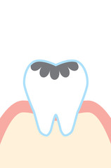 虫歯のかわいい歯のイラスト cute cartoon decayed tooth illustration