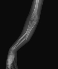  Right forearm x-ray image, front view, show ulna and radius bone fractures (Forearm fractures) 