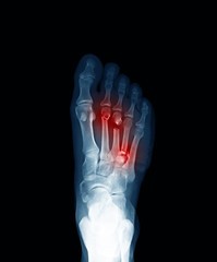 Computed radiography (CR) of foot, anteroposterior (AP)view, showing wonud and metatarsal bone...