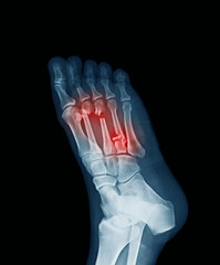 Computed radiography (CR) of foot, oblique view, showing wonud and metatarsal bone fractures
